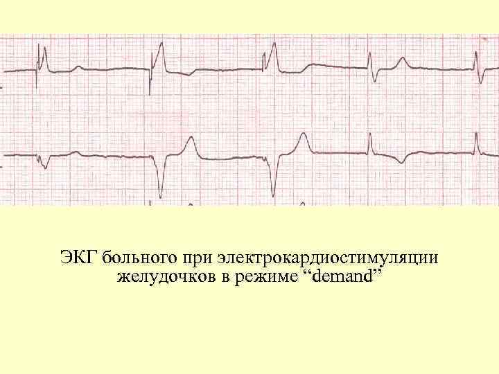 ЭКГ больного при электрокардиостимуляции желудочков в режиме “demand” 