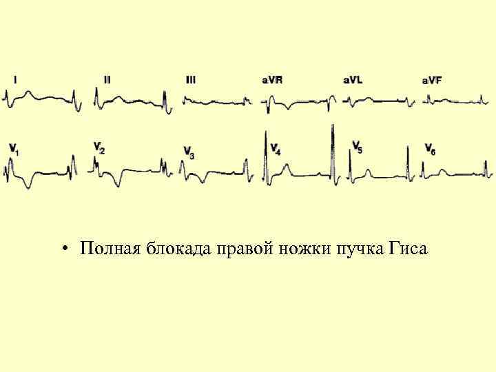  • Полная блокада правой ножки пучка Гиса 