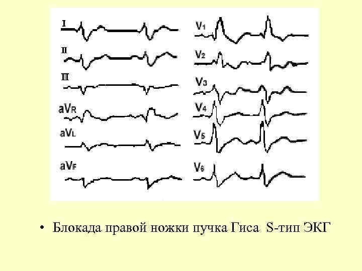  • Блокада правой ножки пучка Гиса S-тип ЭКГ 