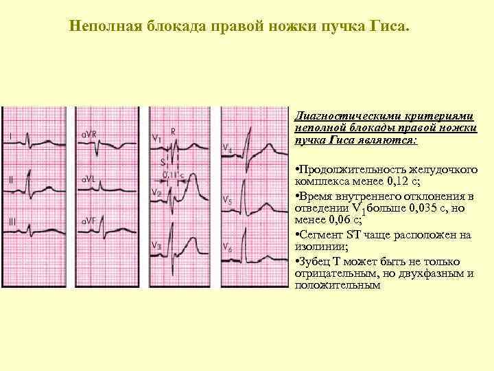 Неполная блокада правой ножки пучка Гиса. Диагностическими критериями неполной блокады правой ножки пучка Гиса