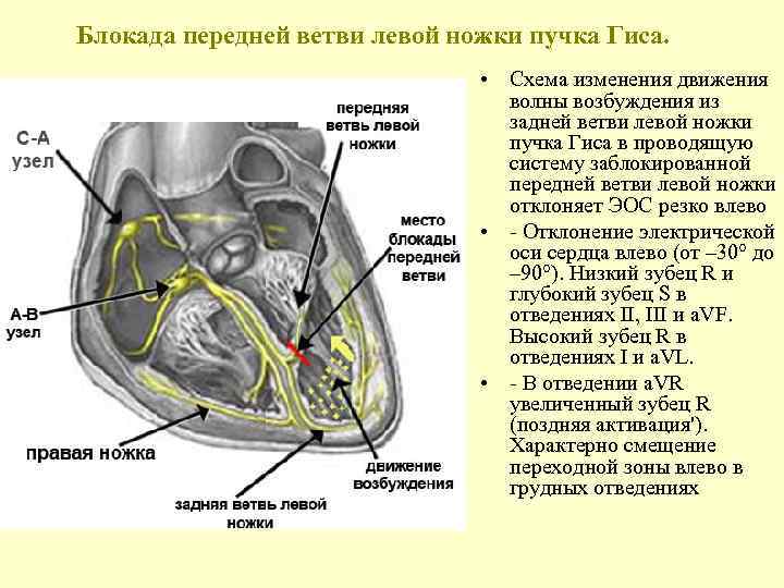 Блокада передней ветви левой ножки пучка Гиса. • Схема изменения движения волны возбуждения из