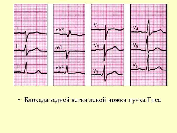  • Блокада задней ветви левой ножки пучка Гиса 