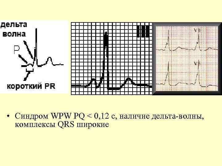  • Синдром WPW PQ < 0, 12 с, наличие дельта-волны, комплексы QRS широкие