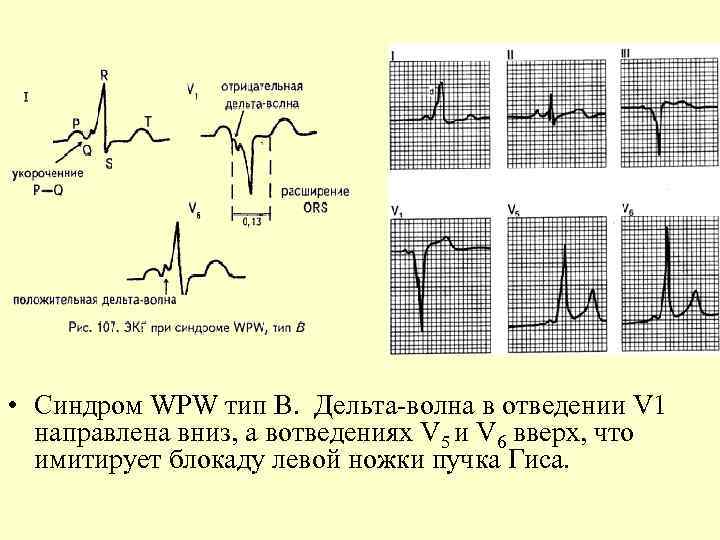  • Синдром WPW тип B. Дельта-волна в отведении V 1 направлена вниз, а