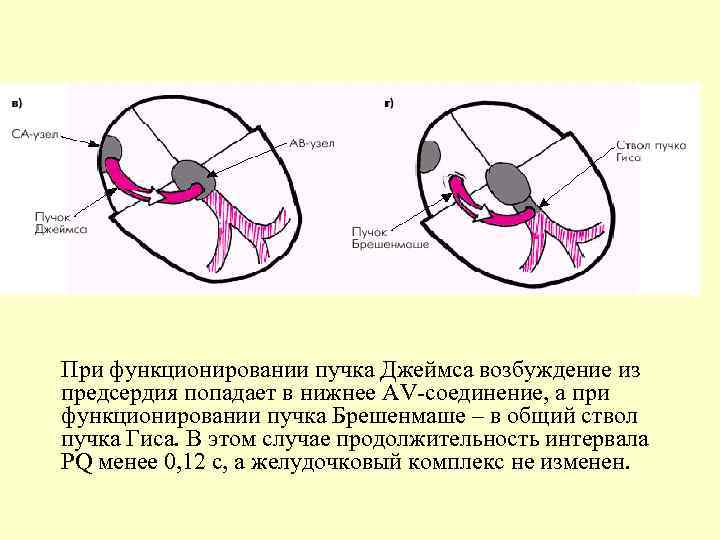 При функционировании пучка Джеймса возбуждение из предсердия попадает в нижнее AV-соединение, а при функционировании