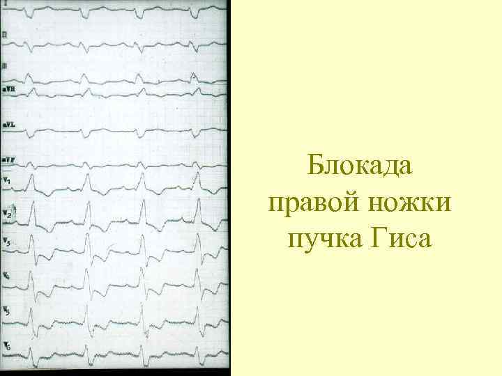 Блокада правой ножки пучка Гиса 