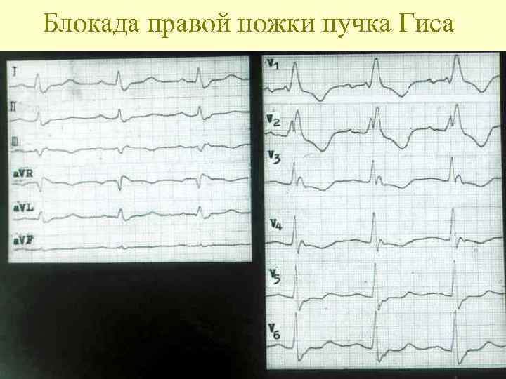 Блокада правой ножки пучка Гиса 