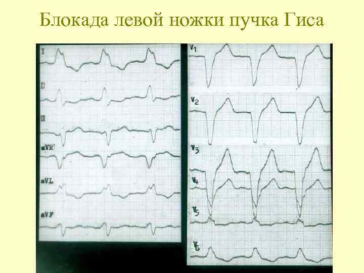 Блокада левой ножки пучка Гиса 