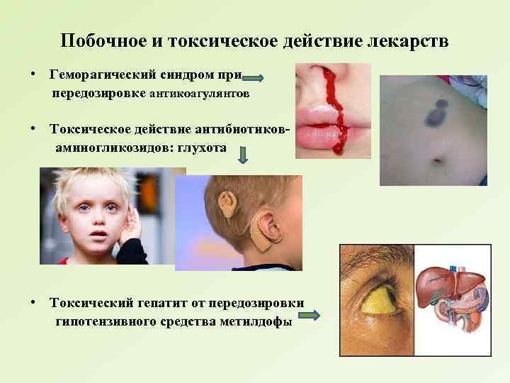 Побочное и токсическое действие лекарств • Геморагический синдром при передозировке антикоагулянтов • Токсическое действие