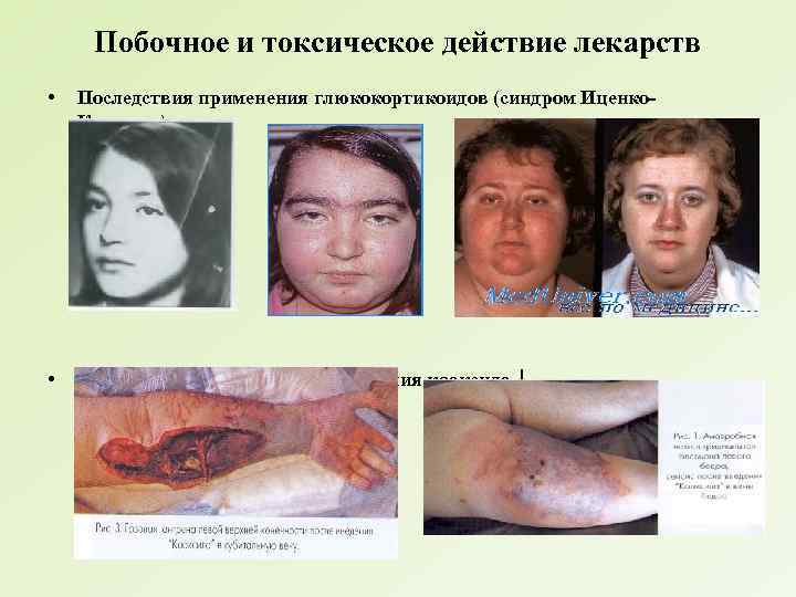 Побочное и токсическое действие лекарств • Последствия применения глюкокортикоидов (синдром Иценко. Кушинга) • Последствия