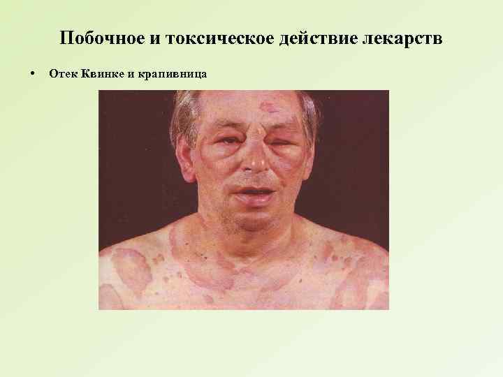 Побочное и токсическое действие лекарств • Отек Квинке и крапивница 