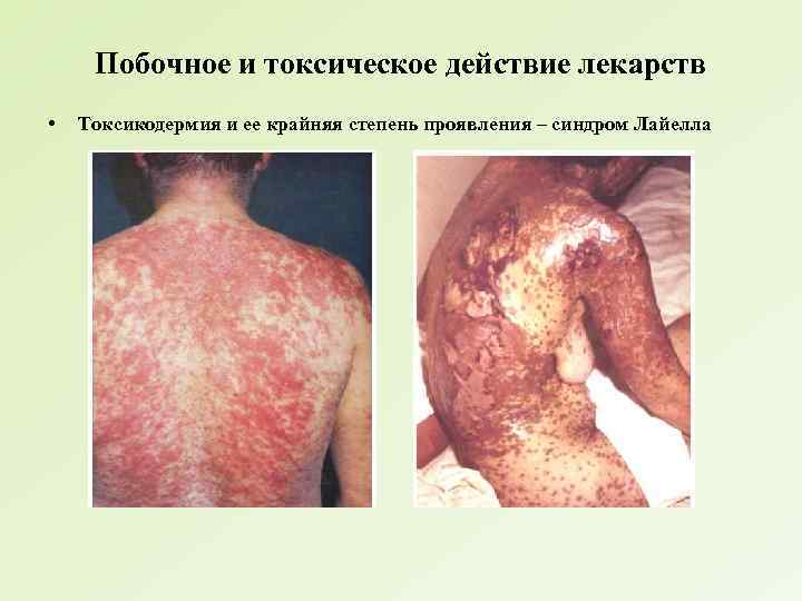 Побочное и токсическое действие лекарств • Токсикодермия и ее крайняя степень проявления – синдром