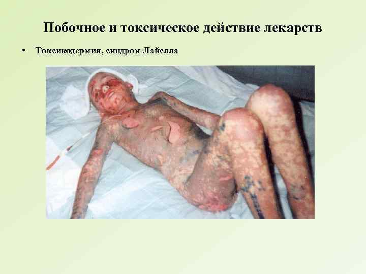 Побочное и токсическое действие лекарств • Токсикодермия, синдром Лайелла 