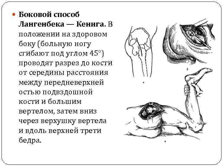  Боковой способ Лангенбека — Кенига. В положении на здоровом боку (больную ногу сгибают