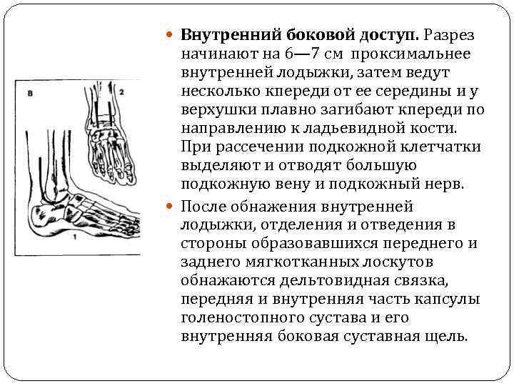  Внутренний боковой доступ. Разрез начинают на 6— 7 см проксимальнее внутренней лодыжки, затем
