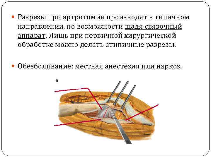  Разрезы при артротомии производят в типичном направлении, по возможности щадя связочный аппарат. Лишь