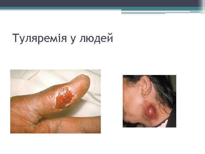 Туляремія у людей 