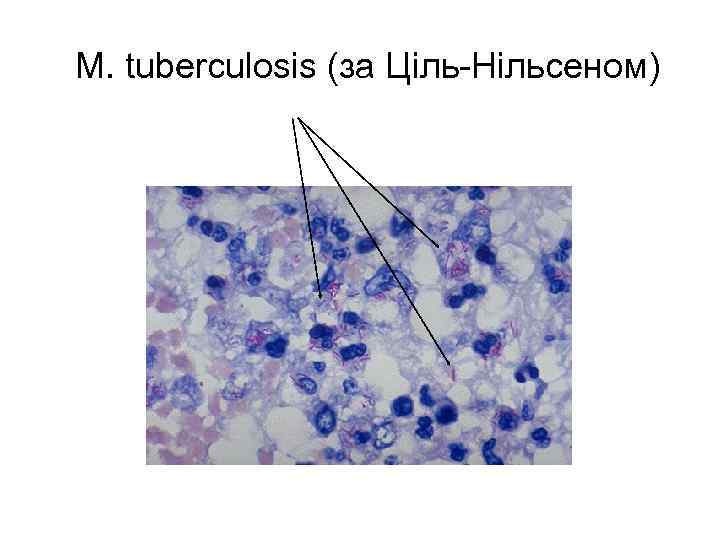 M. tuberculosis (за Ціль-Нільсеном) 