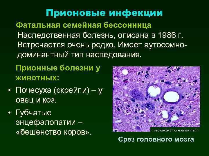 Фатальная семейная бессонница фото