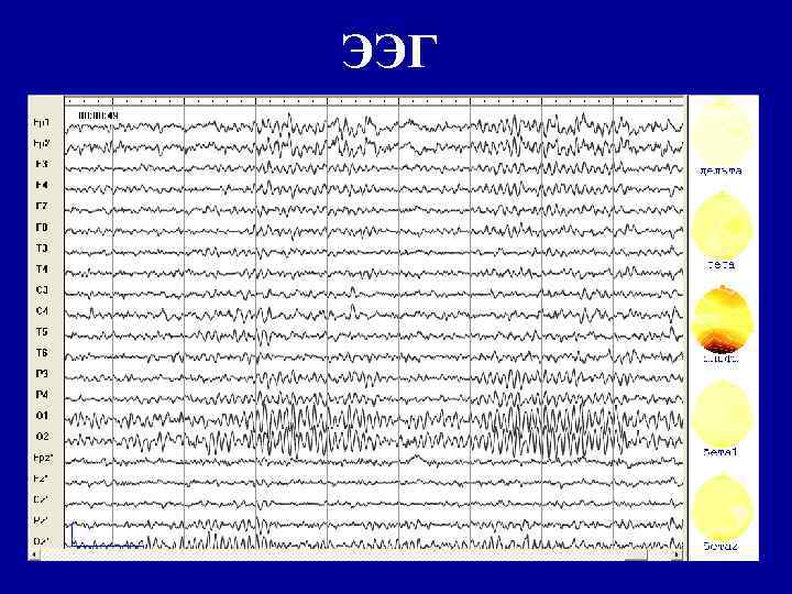 ЭЭГ 