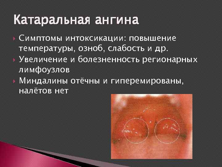Катаральная ангина Симптомы интоксикации: повышение температуры, озноб, слабость и др. Увеличение и болезненность регионарных