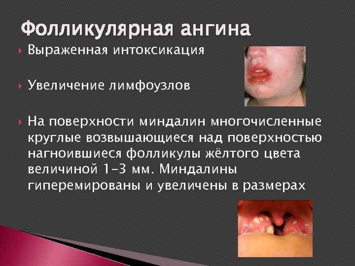 Фолликулярная ангина Выраженная интоксикация Увеличение лимфоузлов На поверхности миндалин многочисленные круглые возвышающиеся над поверхностью