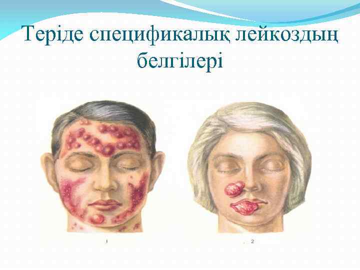 Теріде спецификалық лейкоздың белгілері 