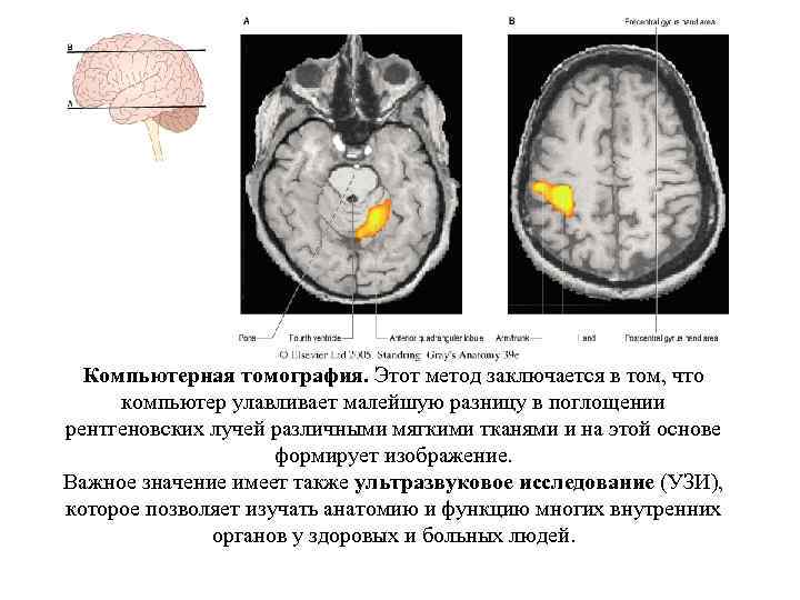 Компьютерная томография. Этот метод заключается в том, что компьютер улавливает малейшую разницу в поглощении