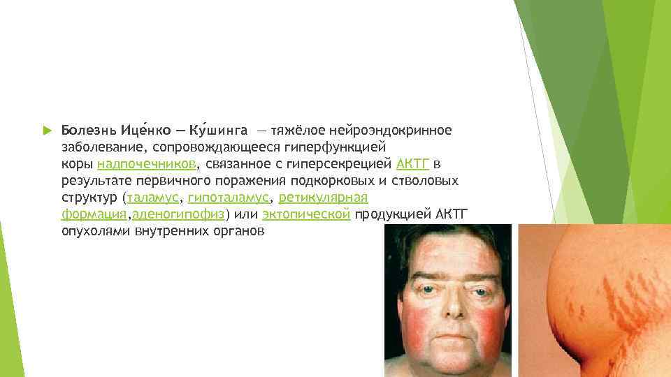  Болезнь Ице нко — Ку шинга — тяжёлое нейроэндокринное заболевание, сопровождающееся гиперфункцией коры