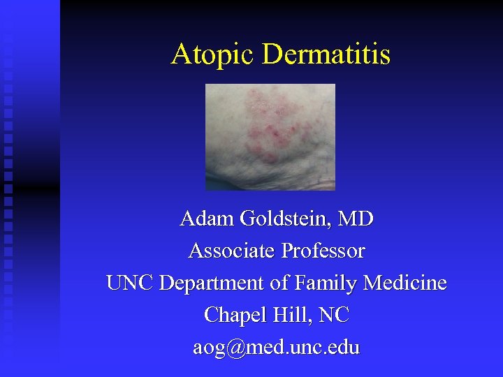 Atopic Dermatitis Adam Goldstein, MD Associate Professor UNC Department of Family Medicine Chapel Hill,
