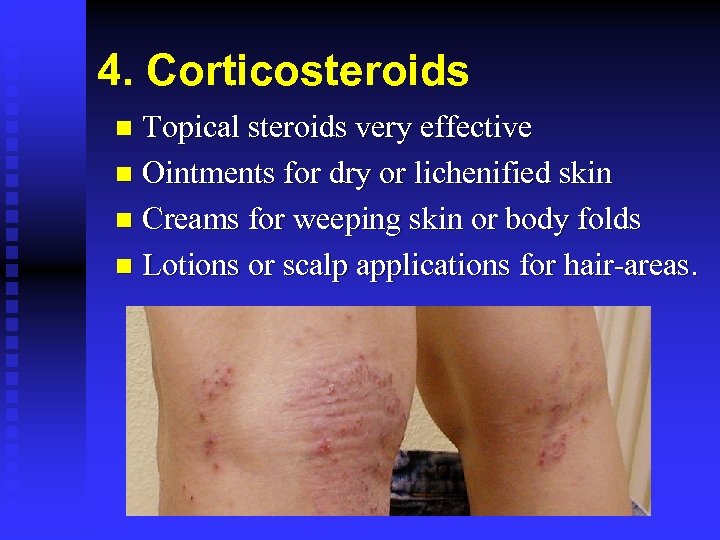 4. Corticosteroids Topical steroids very effective n Ointments for dry or lichenified skin n