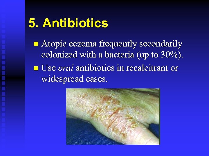 5. Antibiotics Atopic eczema frequently secondarily colonized with a bacteria (up to 30%). n