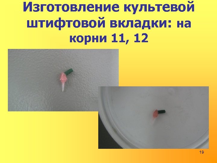 Изготовление культевой штифтовой вкладки: на корни 11, 12 19 