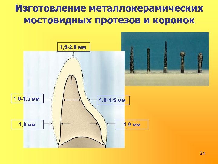 Изготовление металлокерамических мостовидных протезов и коронок 1, 5 -2, 0 мм 1, 0 -1,