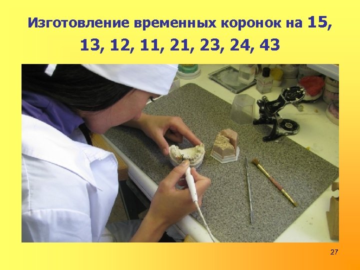 Изготовление временных коронок на 15, 13, 12, 11, 23, 24, 43 27 