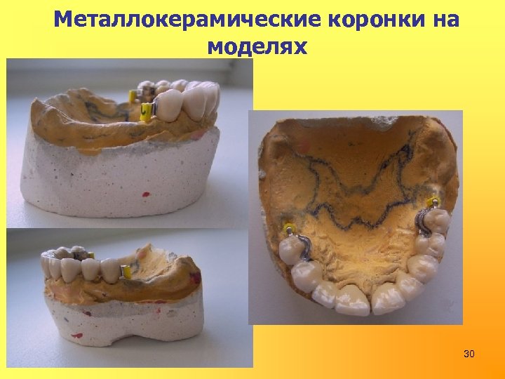 Металлокерамические коронки на моделях 30 