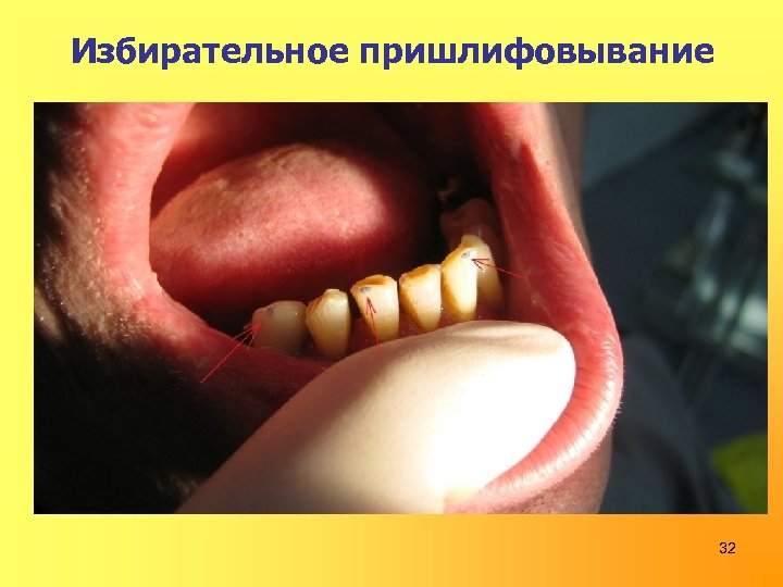 Избирательное пришлифовывание 32 