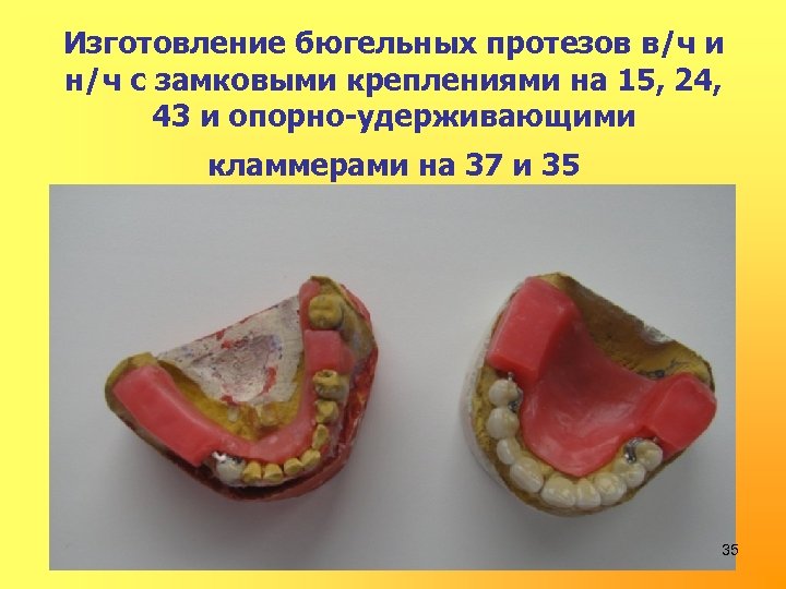 Изготовление бюгельных протезов в/ч и н/ч с замковыми креплениями на 15, 24, 43 и