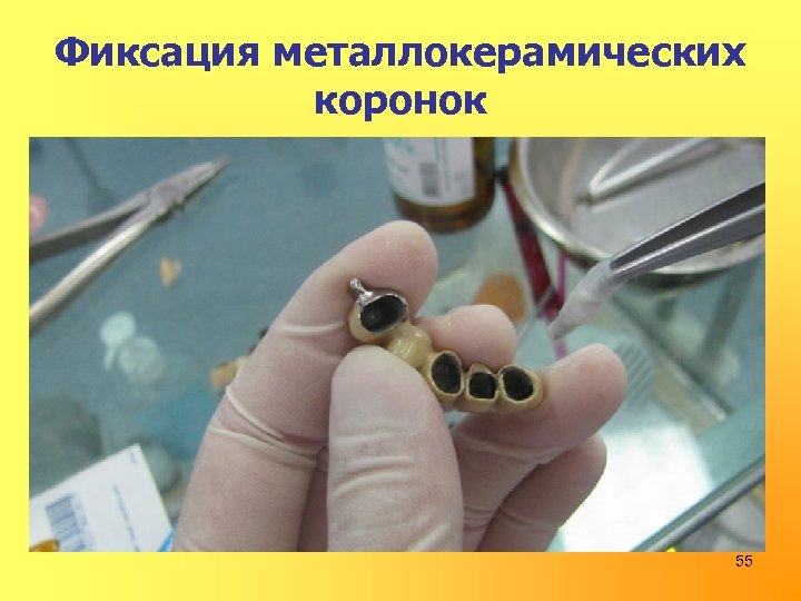 Фиксация металлокерамических коронок 55 