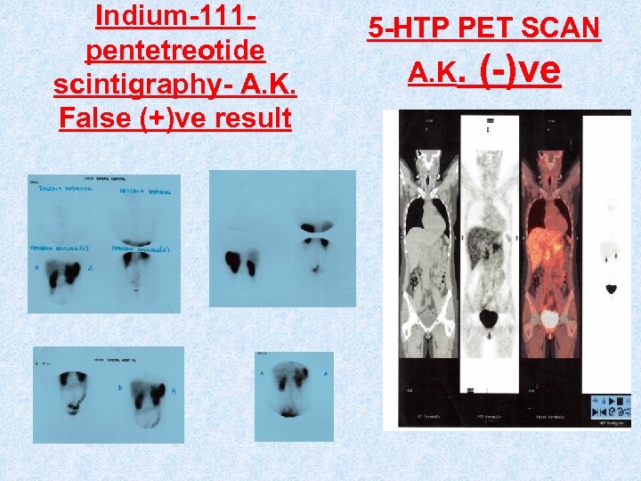 Indium-111 pentetreotide scintigraphy- A. K. False (+)ve result 5 -HTP PET SCAN A. K.