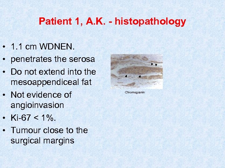 Patient 1, A. K. - histopathology • 1. 1 cm WDNEN. • penetrates the