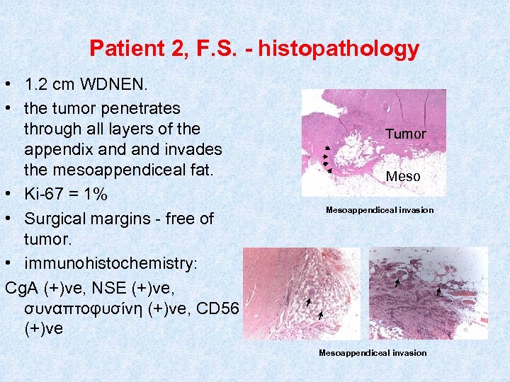 Patient 2, F. S. - histopathology • 1. 2 cm WDNEN. • the tumor