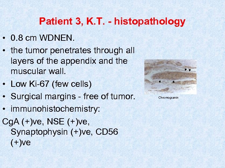 Patient 3, K. T. - histopathology • 0. 8 cm WDNEN. • the tumor