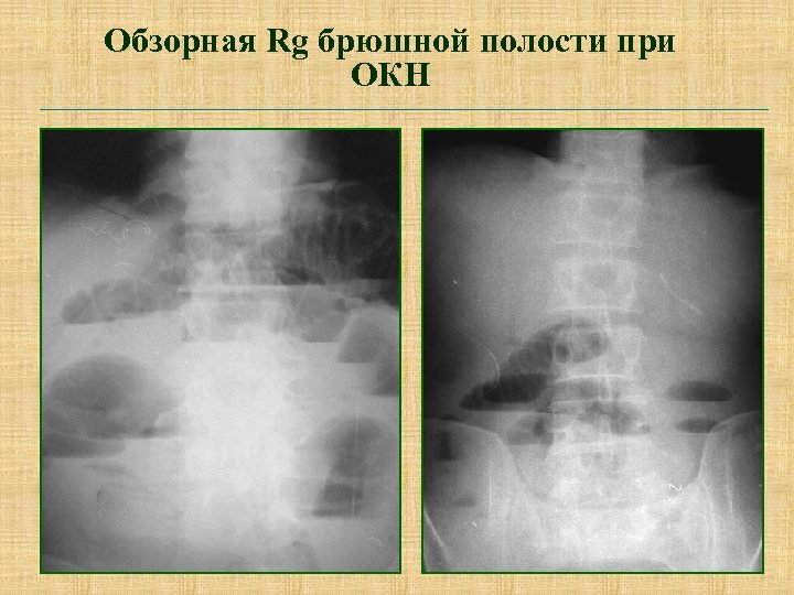 Обзорная Rg брюшной полости при ОКН 