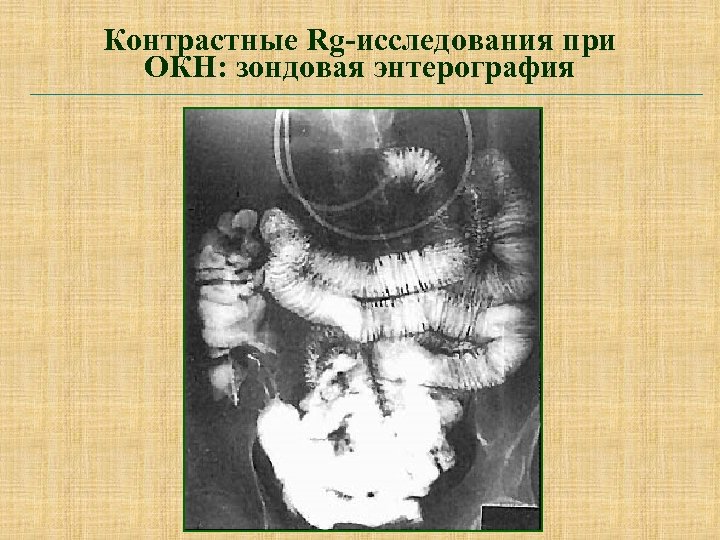 Контрастные Rg-исследования при ОКН: зондовая энтерография 