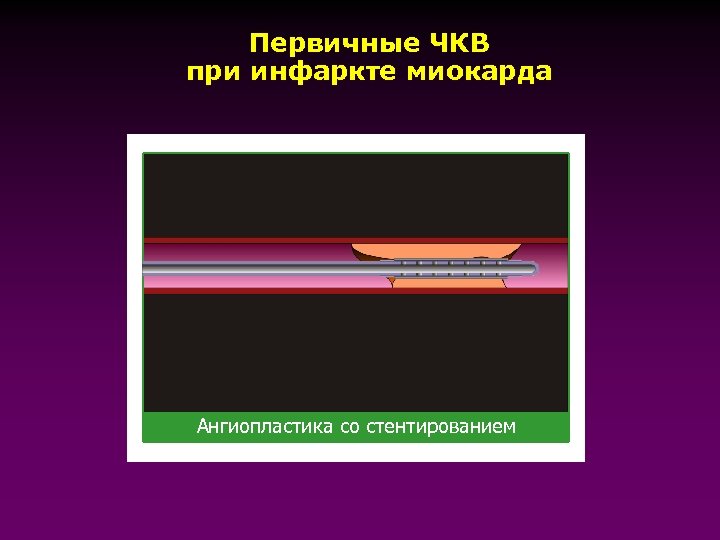 Чкв в кардиологии. ЧКВ при инфаркте миокарда. Первичное ЧКВ. Первичная ЧКВ при инфаркте. Чрескожное коронарное вмешательство при инфаркте миокарда.