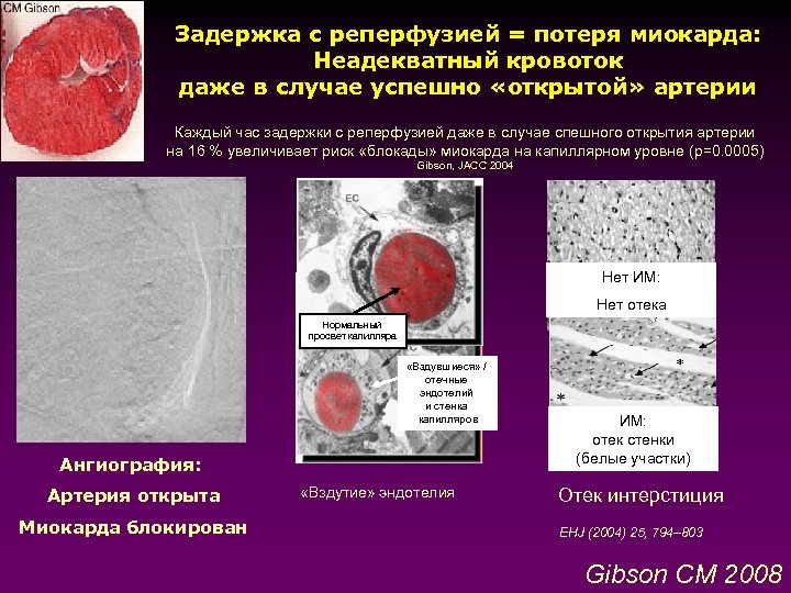 Задержка с реперфузией = потеря миокарда: Неадекватный кровоток даже в случае успешно «открытой» артерии