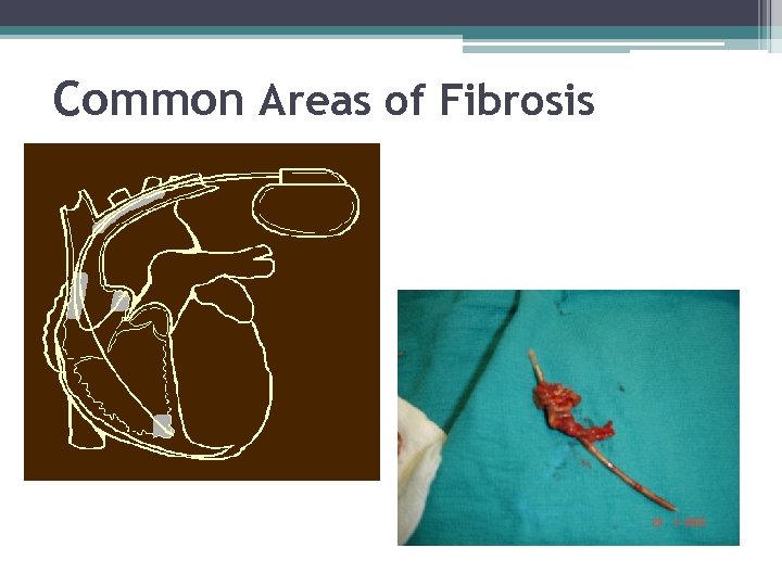 Common Areas of Fibrosis 
