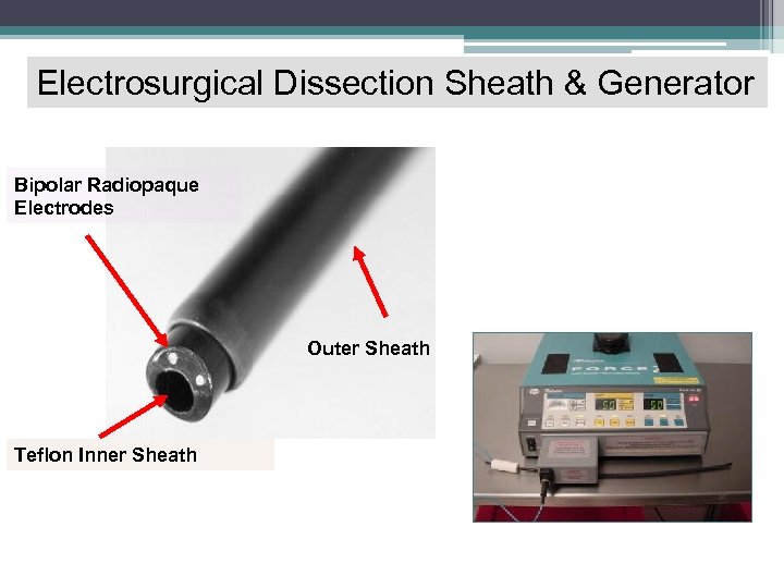 Electrosurgical Dissection Sheath & Generator Bipolar Radiopaque Electrodes Outer Sheath Teflon Inner Sheath 