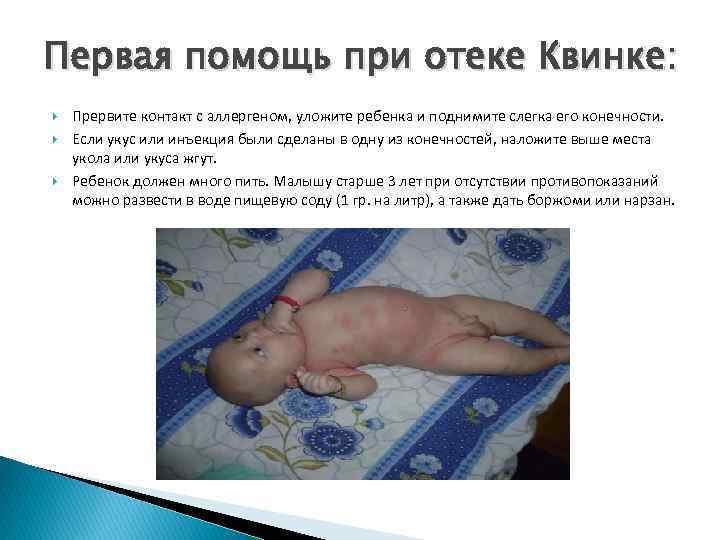 Первая помощь при отеке Квинке: Прервите контакт с аллергеном, уложите ребенка и поднимите слегка